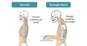 整骨院・整体院との差別化はここにある！ストレートネック専門院の強みとは